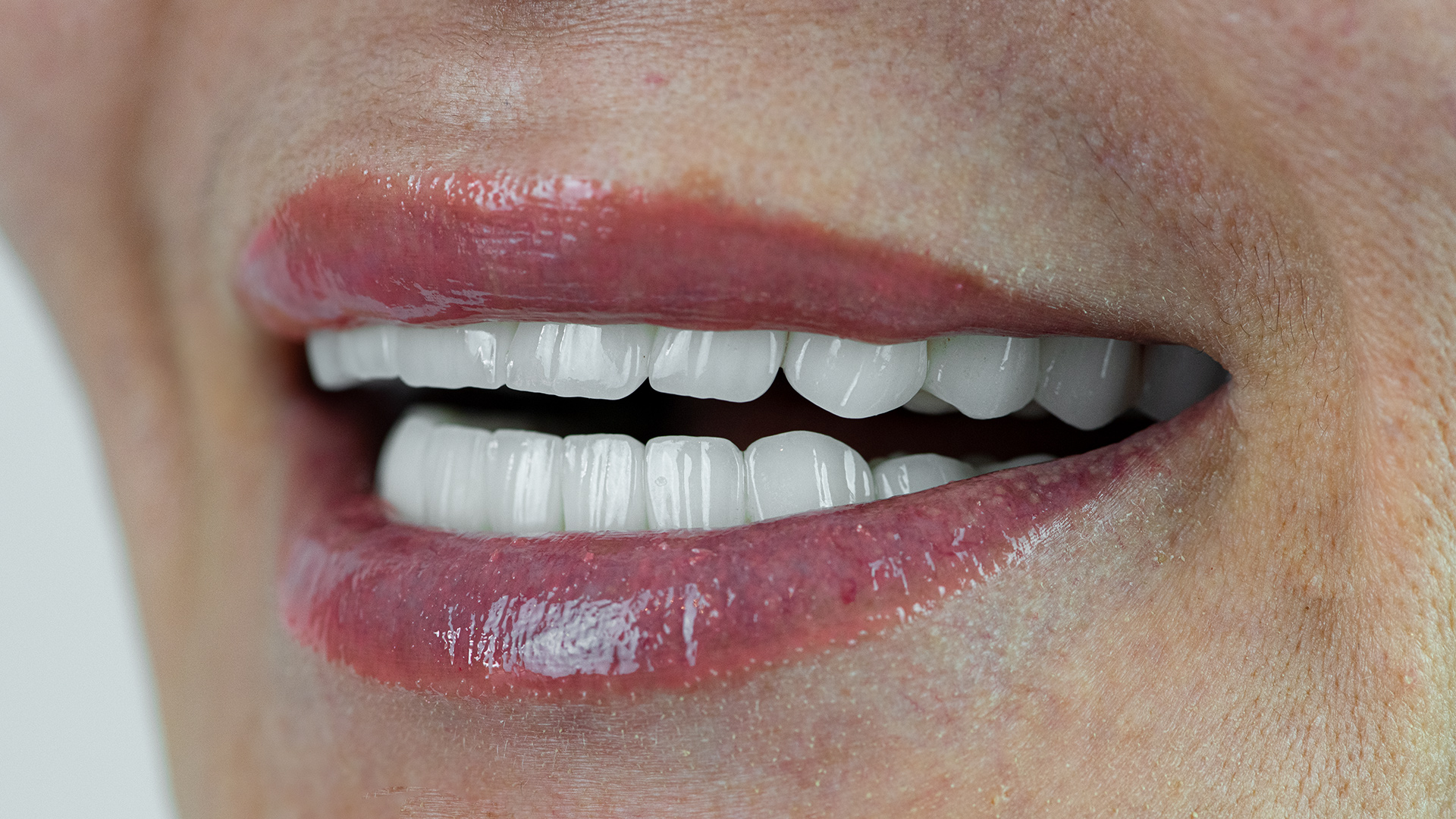 Smile Design